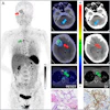 (A) Ga-68 NK224 PET/CT maximum intensity projection image (left), axial PET/CT images (center), and axial CT images (right) in a 43-year-old female participant with lung adenocarcinoma show lesions in the right cerebellum (blue arrow), right frontal lobe (red arrow), and sternum (green arrow) with low, intermediate, and high tracer uptake, respectively. Photomicrographs (scale bar, 100 μm) with hematoxylin-eosin (H&E) staining (center bottom) and programmed death ligand 1 (PD-L1) immunohistochemical (IHC) staining (right bottom) show high PD-L1 expression in the sternal lesion (tumor proportion score ≥ 50%).