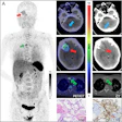 (A) Ga-68 NK224 PET/CT maximum intensity projection image (left), axial PET/CT images (center), and axial CT images (right) in a 43-year-old female participant with lung adenocarcinoma show lesions in the right cerebellum (blue arrow), right frontal lobe (red arrow), and sternum (green arrow) with low, intermediate, and high tracer uptake, respectively. Photomicrographs (scale bar, 100 μm) with hematoxylin-eosin (H&E) staining (center bottom) and programmed death ligand 1 (PD-L1) immunohistochemical (IHC) staining (right bottom) show high PD-L1 expression in the sternal lesion (tumor proportion score ≥ 50%).