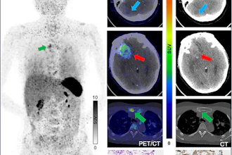 (A) Ga-68 NK224 PET/CT maximum intensity projection image (left), axial PET/CT images (center), and axial CT images (right) in a 43-year-old female participant with lung adenocarcinoma show lesions in the right cerebellum (blue arrow), right frontal lobe (red arrow), and sternum (green arrow) with low, intermediate, and high tracer uptake, respectively. Photomicrographs (scale bar, 100 μm) with hematoxylin-eosin (H&E) staining (center bottom) and programmed death ligand 1 (PD-L1) immunohistochemical (IHC) staining (right bottom) show high PD-L1 expression in the sternal lesion (tumor proportion score ≥ 50%).