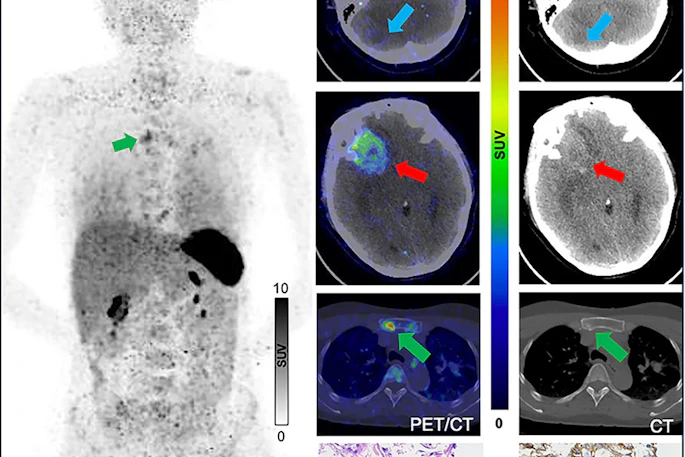 (A) Ga-68 NK224 PET/CT maximum intensity projection image (left), axial PET/CT images (center), and axial CT images (right) in a 43-year-old female participant with lung adenocarcinoma show lesions in the right cerebellum (blue arrow), right frontal lobe (red arrow), and sternum (green arrow) with low, intermediate, and high tracer uptake, respectively. Photomicrographs (scale bar, 100 μm) with hematoxylin-eosin (H&E) staining (center bottom) and programmed death ligand 1 (PD-L1) immunohistochemical (IHC) staining (right bottom) show high PD-L1 expression in the sternal lesion (tumor proportion score ≥ 50%).