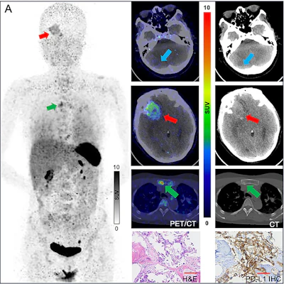 (A) Ga-68 NK224 PET/CT maximum intensity projection image (left), axial PET/CT images (center), and axial CT images (right) in a 43-year-old female participant with lung adenocarcinoma show lesions in the right cerebellum (blue arrow), right frontal lobe (red arrow), and sternum (green arrow) with low, intermediate, and high tracer uptake, respectively. Photomicrographs (scale bar, 100 μm) with hematoxylin-eosin (H&E) staining (center bottom) and programmed death ligand 1 (PD-L1) immunohistochemical (IHC) staining (right bottom) show high PD-L1 expression in the sternal lesion (tumor proportion score ≥ 50%).