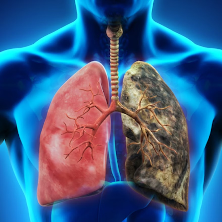 Lung Cancer