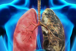 Lung Cancer