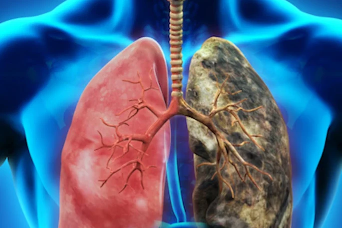 Lung Cancer