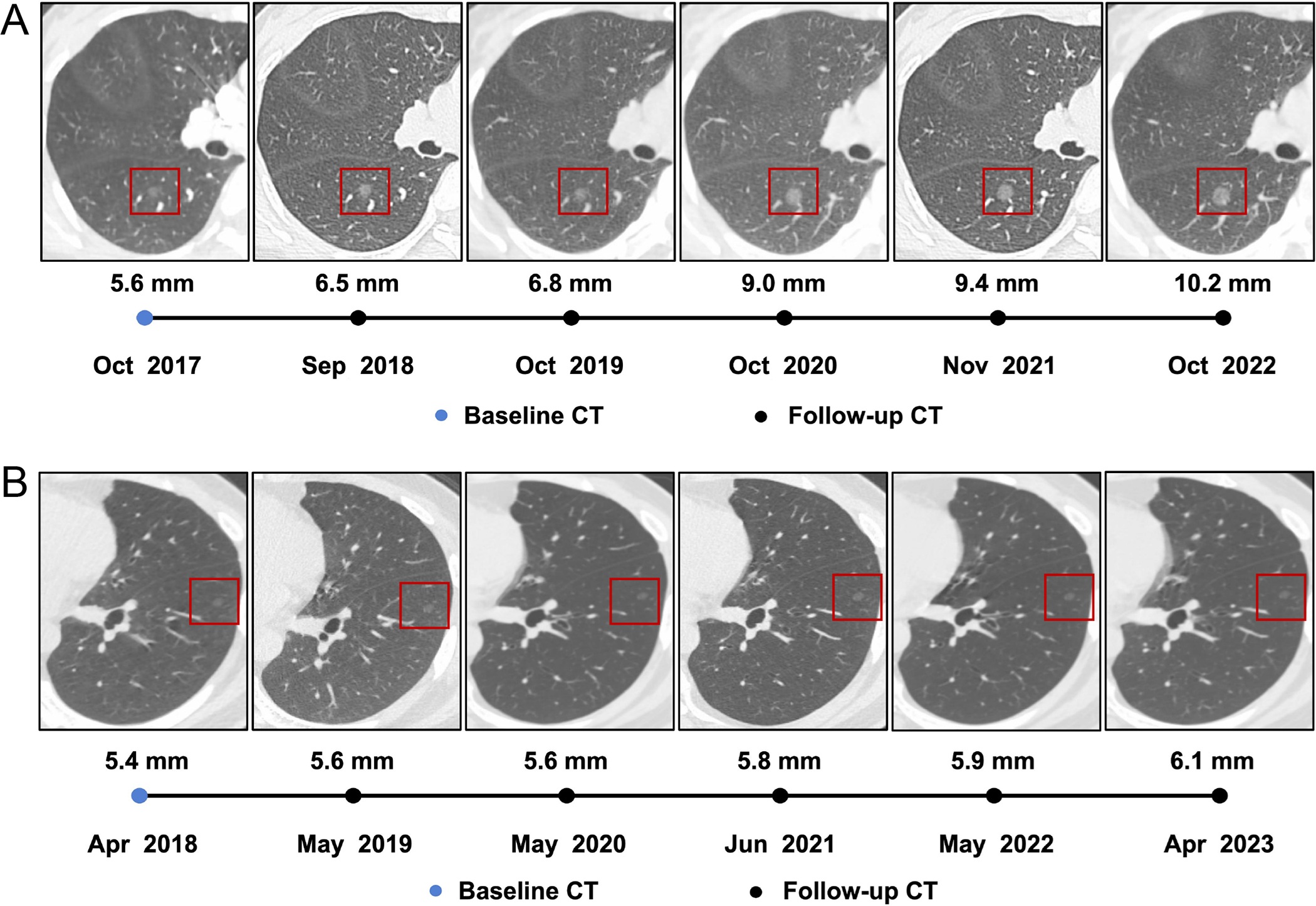 Serial axial chest CT scans demonstrating the longitudinal evolution of small pure ground-glass nodules (pGGNs) incidentally detected during a routine wellness assessment. (A) Images in a 37-year-old woman with a family history of lung cancer show a nodule with the progressive growth pattern (box). The baseline CT scan, obtained in October 2017, demonstrates a pure ground-glass nodules in the right lower lobe. Consecutive CT scans obtained from 2017 to 2022 show the continuous enlargement of the nodule during active surveillance. The maximum diameter of the nodule increased from 5.6 mm in 2017 to 10.2 mm in 2022. (B) Images in a 45-year-old man show a nodule with the indolent growth pattern (box). The baseline CT scan, obtained in April 2018, demonstrates a pure ground-glass nodules in the left lower lobe. Consecutive CT scans obtained from 2019 to 2023 show that the nodule remained radiographically stable during CT surveillance. The maximum diameter of the nodule was 5.4 mm in 2018 and 6.1 mm at the final surveillance scan in 2023.