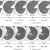 Serial axial chest CT scans demonstrating the longitudinal evolution of small pure ground-glass nodules (pGGNs) incidentally detected during a routine wellness assessment. (A) Images in a 37-year-old woman with a family history of lung cancer show a nodule with the progressive growth pattern (box). The baseline CT scan, obtained in October 2017, demonstrates a pure ground-glass nodules in the right lower lobe. Consecutive CT scans obtained from 2017 to 2022 show the continuous enlargement of the nodule during active surveillance. The maximum diameter of the nodule increased from 5.6 mm in 2017 to 10.2 mm in 2022. (B) Images in a 45-year-old man show a nodule with the indolent growth pattern (box). The baseline CT scan, obtained in April 2018, demonstrates a pure ground-glass nodules in the left lower lobe. Consecutive CT scans obtained from 2019 to 2023 show that the nodule remained radiographically stable during CT surveillance. The maximum diameter of the nodule was 5.4 mm in 2018 and 6.1 mm at the final surveillance scan in 2023.