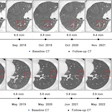 Serial axial chest CT scans demonstrating the longitudinal evolution of small pure ground-glass nodules (pGGNs) incidentally detected during a routine wellness assessment. (A) Images in a 37-year-old woman with a family history of lung cancer show a nodule with the progressive growth pattern (box). The baseline CT scan, obtained in October 2017, demonstrates a pure ground-glass nodules in the right lower lobe. Consecutive CT scans obtained from 2017 to 2022 show the continuous enlargement of the nodule during active surveillance. The maximum diameter of the nodule increased from 5.6 mm in 2017 to 10.2 mm in 2022. (B) Images in a 45-year-old man show a nodule with the indolent growth pattern (box). The baseline CT scan, obtained in April 2018, demonstrates a pure ground-glass nodules in the left lower lobe. Consecutive CT scans obtained from 2019 to 2023 show that the nodule remained radiographically stable during CT surveillance. The maximum diameter of the nodule was 5.4 mm in 2018 and 6.1 mm at the final surveillance scan in 2023.