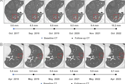 Serial axial chest CT scans demonstrating the longitudinal evolution of small pure ground-glass nodules (pGGNs) incidentally detected during a routine wellness assessment. (A) Images in a 37-year-old woman with a family history of lung cancer show a nodule with the progressive growth pattern (box). The baseline CT scan, obtained in October 2017, demonstrates a pure ground-glass nodules in the right lower lobe. Consecutive CT scans obtained from 2017 to 2022 show the continuous enlargement of the nodule during active surveillance. The maximum diameter of the nodule increased from 5.6 mm in 2017 to 10.2 mm in 2022. (B) Images in a 45-year-old man show a nodule with the indolent growth pattern (box). The baseline CT scan, obtained in April 2018, demonstrates a pure ground-glass nodules in the left lower lobe. Consecutive CT scans obtained from 2019 to 2023 show that the nodule remained radiographically stable during CT surveillance. The maximum diameter of the nodule was 5.4 mm in 2018 and 6.1 mm at the final surveillance scan in 2023.