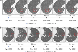 Serial axial chest CT scans demonstrating the longitudinal evolution of small pure ground-glass nodules (pGGNs) incidentally detected during a routine wellness assessment. (A) Images in a 37-year-old woman with a family history of lung cancer show a nodule with the progressive growth pattern (box). The baseline CT scan, obtained in October 2017, demonstrates a pure ground-glass nodules in the right lower lobe. Consecutive CT scans obtained from 2017 to 2022 show the continuous enlargement of the nodule during active surveillance. The maximum diameter of the nodule increased from 5.6 mm in 2017 to 10.2 mm in 2022. (B) Images in a 45-year-old man show a nodule with the indolent growth pattern (box). The baseline CT scan, obtained in April 2018, demonstrates a pure ground-glass nodules in the left lower lobe. Consecutive CT scans obtained from 2019 to 2023 show that the nodule remained radiographically stable during CT surveillance. The maximum diameter of the nodule was 5.4 mm in 2018 and 6.1 mm at the final surveillance scan in 2023.