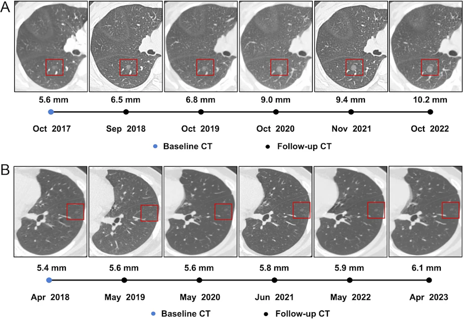 CT reveals progressive growth pattern in incidental lung nodules