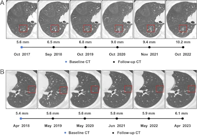 Serial axial chest CT scans demonstrating the longitudinal evolution of small pure ground-glass nodules (pGGNs) incidentally detected during a routine wellness assessment. (A) Images in a 37-year-old woman with a family history of lung cancer show a nodule with the progressive growth pattern (box). The baseline CT scan, obtained in October 2017, demonstrates a pure ground-glass nodules in the right lower lobe. Consecutive CT scans obtained from 2017 to 2022 show the continuous enlargement of the nodule during active surveillance. The maximum diameter of the nodule increased from 5.6 mm in 2017 to 10.2 mm in 2022. (B) Images in a 45-year-old man show a nodule with the indolent growth pattern (box). The baseline CT scan, obtained in April 2018, demonstrates a pure ground-glass nodules in the left lower lobe. Consecutive CT scans obtained from 2019 to 2023 show that the nodule remained radiographically stable during CT surveillance. The maximum diameter of the nodule was 5.4 mm in 2018 and 6.1 mm at the final surveillance scan in 2023.