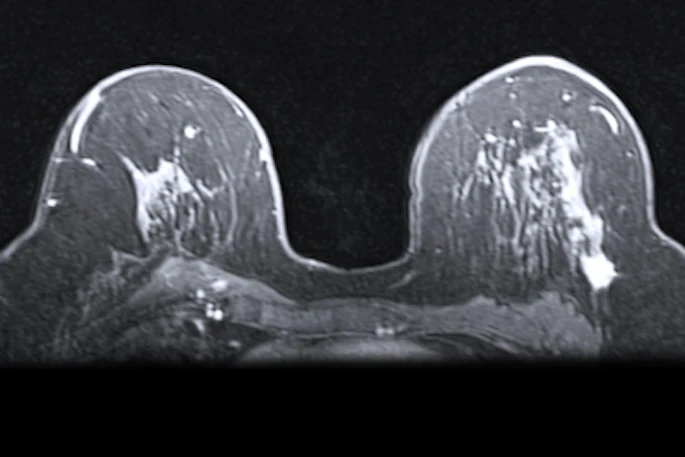 Mri Breast 400