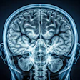 Mri Scan Brain