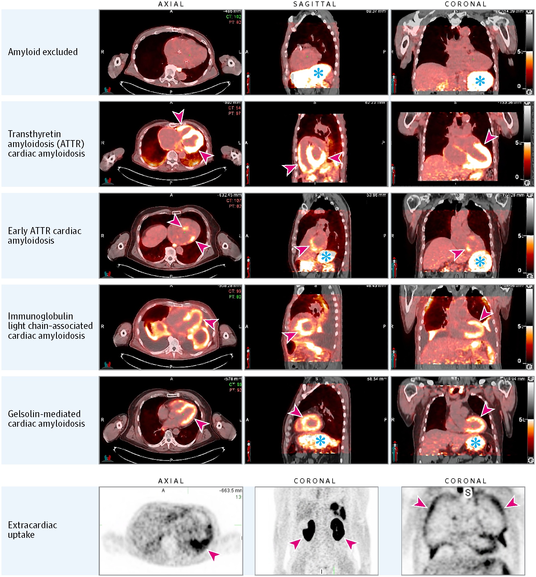 This figure shows fused I-124 evuzamitide positron emission tomography (PET)/computed tomography (CT) images from patients without amyloidosis and from patients with ATTR cardiac amyloidosis, early ATTR cardiac amyloidosis, light chain cardiac amyloidosis, gelsolin-mediated amyloidosis, and systemic organ amyloid. The columns represent radiological transaxial, sagittal, and coronal views except for the last row middle and far right columns, which are coronal projections. The blue asterisks represent physiological activity (tracer activity in the stomach and esophagus). The arrowheads represent pathological uptake. Note the small amount of cardiac uptake in the basal septum and the basal lateral walls (likely early ATTR cardiac amyloidosis), splenic uptake and pleural uptake in light chain amyloidosis, and cardiac and kidney uptake in gelsolin-mediated amyloidosis. The bright yellow color represents more tracer uptake.
