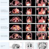 This figure shows fused I-124 evuzamitide positron emission tomography (PET)/computed tomography (CT) images from patients without amyloidosis and from patients with ATTR cardiac amyloidosis, early ATTR cardiac amyloidosis, light chain cardiac amyloidosis, gelsolin-mediated amyloidosis, and systemic organ amyloid. The columns represent radiological transaxial, sagittal, and coronal views except for the last row middle and far right columns, which are coronal projections. The blue asterisks represent physiological activity (tracer activity in the stomach and esophagus). The arrowheads represent pathological uptake. Note the small amount of cardiac uptake in the basal septum and the basal lateral walls (likely early ATTR cardiac amyloidosis), splenic uptake and pleural uptake in light chain amyloidosis, and cardiac and kidney uptake in gelsolin-mediated amyloidosis. The bright yellow color represents more tracer uptake.