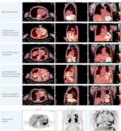 This figure shows fused I-124 evuzamitide positron emission tomography (PET)/computed tomography (CT) images from patients without amyloidosis and from patients with ATTR cardiac amyloidosis, early ATTR cardiac amyloidosis, light chain cardiac amyloidosis, gelsolin-mediated amyloidosis, and systemic organ amyloid. The columns represent radiological transaxial, sagittal, and coronal views except for the last row middle and far right columns, which are coronal projections. The blue asterisks represent physiological activity (tracer activity in the stomach and esophagus). The arrowheads represent pathological uptake. Note the small amount of cardiac uptake in the basal septum and the basal lateral walls (likely early ATTR cardiac amyloidosis), splenic uptake and pleural uptake in light chain amyloidosis, and cardiac and kidney uptake in gelsolin-mediated amyloidosis. The bright yellow color represents more tracer uptake.