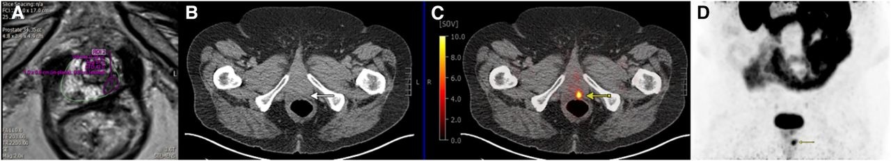 True-positive PSMA-PET with positive MRI in 74-year-old male with prostate cancer (Gleason score of 4 + 5; left anterior and posterior apex positive cores). (A) Left posterior peripheral apical to midprostate hyposignal visible on transaxial MRI. (B) No definite CT correlate evident (white arrow). (C) Focal high PSMA expression detectable in left posterior mid to base with SUVmax of 12.4 on transaxial fused delayed pelvic PET/CT (yellow arrow). (D) Focal high PSMA expression found in left midgland to base of prostate on maximum-intensity-projection image (yellow arrow).