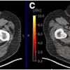 True-positive PSMA-PET with positive MRI in 74-year-old male with prostate cancer (Gleason score of 4 + 5; left anterior and posterior apex positive cores). (A) Left posterior peripheral apical to midprostate hyposignal visible on transaxial MRI. (B) No definite CT correlate evident (white arrow). (C) Focal high PSMA expression detectable in left posterior mid to base with SUVmax of 12.4 on transaxial fused delayed pelvic PET/CT (yellow arrow). (D) Focal high PSMA expression found in left midgland to base of prostate on maximum-intensity-projection image (yellow arrow).
