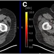 True-positive PSMA-PET with positive MRI in 74-year-old male with prostate cancer (Gleason score of 4 + 5; left anterior and posterior apex positive cores). (A) Left posterior peripheral apical to midprostate hyposignal visible on transaxial MRI. (B) No definite CT correlate evident (white arrow). (C) Focal high PSMA expression detectable in left posterior mid to base with SUVmax of 12.4 on transaxial fused delayed pelvic PET/CT (yellow arrow). (D) Focal high PSMA expression found in left midgland to base of prostate on maximum-intensity-projection image (yellow arrow).