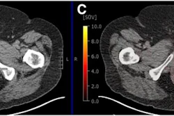 True-positive PSMA-PET with positive MRI in 74-year-old male with prostate cancer (Gleason score of 4 + 5; left anterior and posterior apex positive cores). (A) Left posterior peripheral apical to midprostate hyposignal visible on transaxial MRI. (B) No definite CT correlate evident (white arrow). (C) Focal high PSMA expression detectable in left posterior mid to base with SUVmax of 12.4 on transaxial fused delayed pelvic PET/CT (yellow arrow). (D) Focal high PSMA expression found in left midgland to base of prostate on maximum-intensity-projection image (yellow arrow).