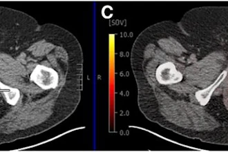 True-positive PSMA-PET with positive MRI in 74-year-old male with prostate cancer (Gleason score of 4 + 5; left anterior and posterior apex positive cores). (A) Left posterior peripheral apical to midprostate hyposignal visible on transaxial MRI. (B) No definite CT correlate evident (white arrow). (C) Focal high PSMA expression detectable in left posterior mid to base with SUVmax of 12.4 on transaxial fused delayed pelvic PET/CT (yellow arrow). (D) Focal high PSMA expression found in left midgland to base of prostate on maximum-intensity-projection image (yellow arrow).