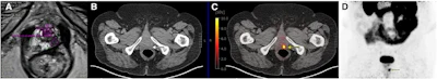 True-positive PSMA-PET with positive MRI in 74-year-old male with prostate cancer (Gleason score of 4 + 5; left anterior and posterior apex positive cores). (A) Left posterior peripheral apical to midprostate hyposignal visible on transaxial MRI. (B) No definite CT correlate evident (white arrow). (C) Focal high PSMA expression detectable in left posterior mid to base with SUVmax of 12.4 on transaxial fused delayed pelvic PET/CT (yellow arrow). (D) Focal high PSMA expression found in left midgland to base of prostate on maximum-intensity-projection image (yellow arrow). True-positive PSMA-PET with positive MRI in 74-year-old male with prostate cancer (Gleason score of 4 + 5; left anterior and posterior apex positive cores). (A) Left posterior peripheral apical to midprostate hyposignal visible on transaxial MRI. (B) No definite CT correlate evident (white arrow). (C) Focal high PSMA expression detectable in left posterior mid to base with SUVmax of 12.4 on transaxial fused delayed pelvic PET/CT (yellow arrow). (D) Focal high PSMA expression found in left midgland to base of prostate on maximum-intensity-projection image (yellow arrow).