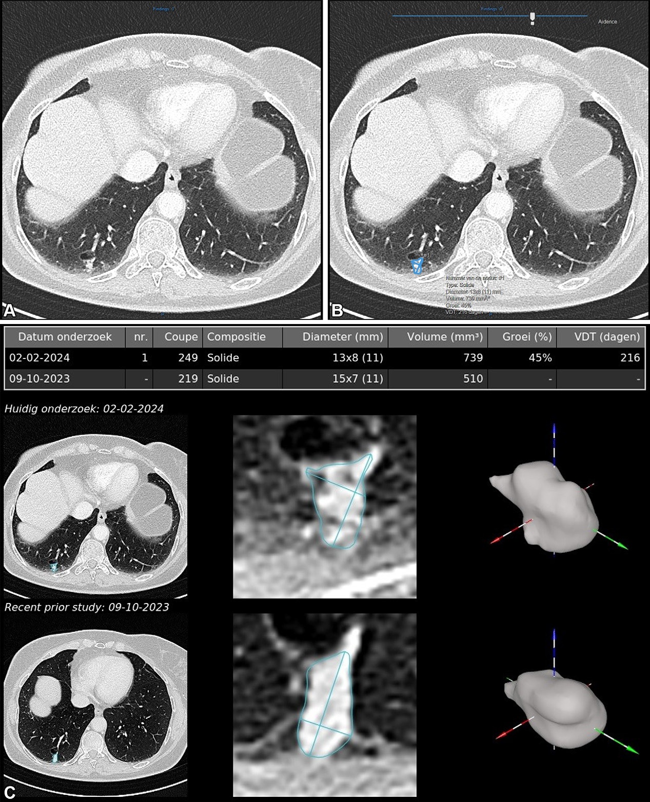 Example of AI-assisted pulmonary nodule detection and longitudinal volumetric assessment in a 65-year-old woman with peripheral arterial disease, a 24-pack-year smoking history, emphysema, and a family history of lung cancer. An incidental 8.5-mm right lower lobe pulmonary nodule is identified at CT angiography of the abdomen in July 2022 but does not receive follow-up. Subsequent imaging demonstrates interval growth, and CT-guided biopsy confirms stage IA lung adenocarcinoma. Contrast-enhanced axial chest CT images obtained on February 2, 2024, before robotic-assisted thoracoscopic segmentectomy, show a 12.1-mm spiculated right lower lobe pulmonary nodule. (A) Conventional contrast-enhanced axial chest CT image without AI assistance shows a 12.1-mm spiculated right lower lobe pulmonary nodule. (B) Corresponding CT image with AI-assisted pulmonary nodule detection, automated segmentation, and quantitative nodule assessment identifies a solid pulmonary nodule (nodule #1) measuring 13 × 8 (11) mm, with a volume of 739 mm3, a 45% volumetric increase compared with the previous contrast-enhanced chest CT performed on October 9, 2023 (510 mm3), and an estimated volume doubling time (VDT) of 216 days. (C) AI-generated longitudinal nodule analysis displays automated segmentation of the current (February 2, 2024) and previous (October 9, 2023) CT examinations, 3D nodule reconstruction, and quantitative volumetric assessment for longitudinal follow-up. The AI interface is displayed in the original software language (Dutch).