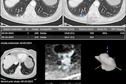 Example of AI-assisted pulmonary nodule detection and longitudinal volumetric assessment in a 65-year-old woman with peripheral arterial disease, a 24-pack-year smoking history, emphysema, and a family history of lung cancer. An incidental 8.5-mm right lower lobe pulmonary nodule is identified at CT angiography of the abdomen in July 2022 but does not receive follow-up. Subsequent imaging demonstrates interval growth, and CT-guided biopsy confirms stage IA lung adenocarcinoma. Contrast-enhanced axial chest CT images obtained on February 2, 2024, before robotic-assisted thoracoscopic segmentectomy, show a 12.1-mm spiculated right lower lobe pulmonary nodule. (A) Conventional contrast-enhanced axial chest CT image without AI assistance shows a 12.1-mm spiculated right lower lobe pulmonary nodule. (B) Corresponding CT image with AI-assisted pulmonary nodule detection, automated segmentation, and quantitative nodule assessment identifies a solid pulmonary nodule (nodule #1) measuring 13 × 8 (11) mm, with a volume of 739 mm3, a 45% volumetric increase compared with the previous contrast-enhanced chest CT performed on October 9, 2023 (510 mm3), and an estimated volume doubling time (VDT) of 216 days. (C) AI-generated longitudinal nodule analysis displays automated segmentation of the current (February 2, 2024) and previous (October 9, 2023) CT examinations, 3D nodule reconstruction, and quantitative volumetric assessment for longitudinal follow-up. The AI interface is displayed in the original software language (Dutch).