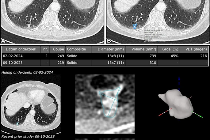 Example of AI-assisted pulmonary nodule detection and longitudinal volumetric assessment in a 65-year-old woman with peripheral arterial disease, a 24-pack-year smoking history, emphysema, and a family history of lung cancer. An incidental 8.5-mm right lower lobe pulmonary nodule is identified at CT angiography of the abdomen in July 2022 but does not receive follow-up. Subsequent imaging demonstrates interval growth, and CT-guided biopsy confirms stage IA lung adenocarcinoma. Contrast-enhanced axial chest CT images obtained on February 2, 2024, before robotic-assisted thoracoscopic segmentectomy, show a 12.1-mm spiculated right lower lobe pulmonary nodule. (A) Conventional contrast-enhanced axial chest CT image without AI assistance shows a 12.1-mm spiculated right lower lobe pulmonary nodule. (B) Corresponding CT image with AI-assisted pulmonary nodule detection, automated segmentation, and quantitative nodule assessment identifies a solid pulmonary nodule (nodule #1) measuring 13 Ă— 8 (11) mm, with a volume of 739 mm3, a 45% volumetric increase compared with the previous contrast-enhanced chest CT performed on October 9, 2023 (510 mm3), and an estimated volume doubling time (VDT) of 216 days. (C) AI-generated longitudinal nodule analysis displays automated segmentation of the current (February 2, 2024) and previous (October 9, 2023) CT examinations, 3D nodule reconstruction, and quantitative volumetric assessment for longitudinal follow-up. The AI interface is displayed in the original software language (Dutch).