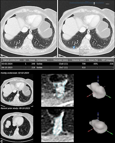 Example of AI-assisted pulmonary nodule detection and longitudinal volumetric assessment in a 65-year-old woman with peripheral arterial disease, a 24-pack-year smoking history, emphysema, and a family history of lung cancer. An incidental 8.5-mm right lower lobe pulmonary nodule is identified at CT angiography of the abdomen in July 2022 but does not receive follow-up. Subsequent imaging demonstrates interval growth, and CT-guided biopsy confirms stage IA lung adenocarcinoma. Contrast-enhanced axial chest CT images obtained on February 2, 2024, before robotic-assisted thoracoscopic segmentectomy, show a 12.1-mm spiculated right lower lobe pulmonary nodule. (A) Conventional contrast-enhanced axial chest CT image without AI assistance shows a 12.1-mm spiculated right lower lobe pulmonary nodule. (B) Corresponding CT image with AI-assisted pulmonary nodule detection, automated segmentation, and quantitative nodule assessment identifies a solid pulmonary nodule (nodule #1) measuring 13 × 8 (11) mm, with a volume of 739 mm3, a 45% volumetric increase compared with the previous contrast-enhanced chest CT performed on October 9, 2023 (510 mm3), and an estimated volume doubling time (VDT) of 216 days. (C) AI-generated longitudinal nodule analysis displays automated segmentation of the current (February 2, 2024) and previous (October 9, 2023) CT examinations, 3D nodule reconstruction, and quantitative volumetric assessment for longitudinal follow-up. The AI interface is displayed in the original software language (Dutch).