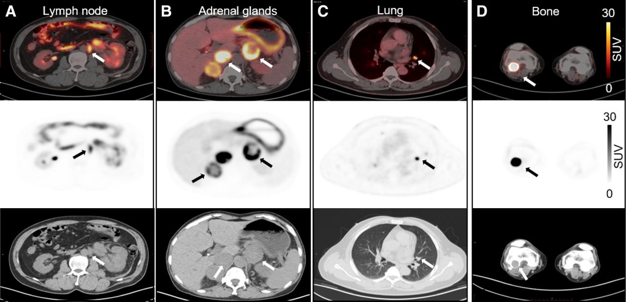 Representative Ga-68 DPI-4452 PET/CT images of regional and distant metastases in ccRCC from multiple patients, including regional lymph node (A), bilateral adrenal glands (B), lung (C), and bone (D). For each panel, top row shows fused PET/CT images, middle row shows PET-only images, and bottom row shows unenhanced CT images. Target lesions are highlighted by white arrows on fused/CT images and black arrows on PET images.