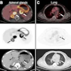 Representative Ga-68 DPI-4452 PET/CT images of regional and distant metastases in ccRCC from multiple patients, including regional lymph node (A), bilateral adrenal glands (B), lung (C), and bone (D). For each panel, top row shows fused PET/CT images, middle row shows PET-only images, and bottom row shows unenhanced CT images. Target lesions are highlighted by white arrows on fused/CT images and black arrows on PET images.