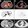 Representative Ga-68 DPI-4452 PET/CT images of regional and distant metastases in ccRCC from multiple patients, including regional lymph node (A), bilateral adrenal glands (B), lung (C), and bone (D). For each panel, top row shows fused PET/CT images, middle row shows PET-only images, and bottom row shows unenhanced CT images. Target lesions are highlighted by white arrows on fused/CT images and black arrows on PET images.