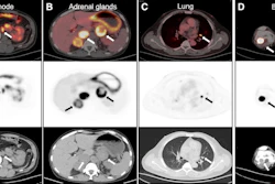 Representative Ga-68 DPI-4452 PET/CT images of regional and distant metastases in ccRCC from multiple patients, including regional lymph node (A), bilateral adrenal glands (B), lung (C), and bone (D). For each panel, top row shows fused PET/CT images, middle row shows PET-only images, and bottom row shows unenhanced CT images. Target lesions are highlighted by white arrows on fused/CT images and black arrows on PET images.