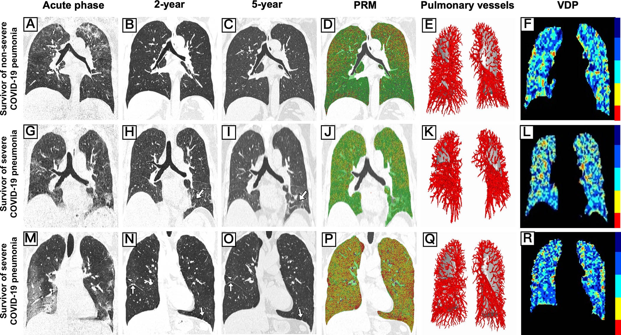 Representative longitudinal chest CT images and five-year parametric response mapping (PRM), pulmonary vascular CT reconstructions, and hyperpolarized xenon-129 (Xe-129) ventilation MRI scans from survivors of nonsevere and severe COVID-19 pneumonia. (A–F) Images in a 68-year-old male survivor of nonsevere COVID-19 pneumonia, (G–L) 62-year-old male survivor of severe COVID-19 pneumonia, and (M–R) 55-year-old male survivor of severe COVID-19 pneumonia. For each participant, the first three columns show coronal chest CT images from the acute phase (A, G, M), two-year follow-up (B, H, N), and five-year follow-up (C, I, O) (left to right). The fourth column (D, J, P) shows a coronal PRM image for each participant at five-year follow-up derived from paired inspiratory and expiratory CT scans, showing the spatial distribution of lung functional categories. Green indicates normal lung tissue, yellow indicates functional small airway disease, and red indicates emphysema. The second-to-last column shows volume-rendered small pulmonary vessel visualization (red) at five-year follow-up per participant (E, K, Q). The column on the far right (F, L, R) shows a hyperpolarized Xe-129 MRI ventilation defect percentage (VDP) map at five-year follow-up per participant. Dark blue represents high Xe-129 signal intensity, corresponding to well-ventilated lung regions, whereas red represents no Xe-129 signal intensity, corresponding to ventilation defects. At five-year follow-up, the 68-year-old survivor of nonsevere COVID-19 pneumonia (top row) showed near-complete radiologic resolution, no respiratory symptoms, and preserved pulmonary function. In contrast, the 62-year-old survivor of severe COVID-19 pneumonia (middle row) showed persistent fibrotic linear opacities without respiratory symptoms and mildly reduced pulmonary function. The 55-year-old survivor of severe COVID-19 pneumonia (bottom row) showed persistent scattered fibrotic linear opacities and focal emphysematous changes in both lungs, with dyspnea and impaired gas exchange function. The VDP values obtained from F, L, and R were 7.7%, 7.1%, and 6.3%, respectively.