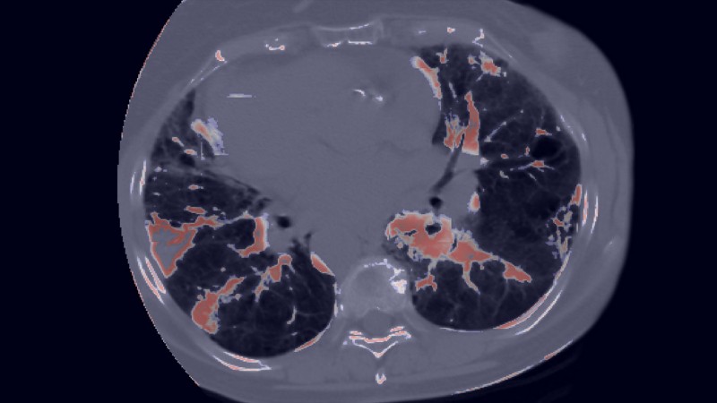 CIPHER, an AI-powered CT foundation model, identifies patients with lung cancer at increased risk of immunotherapy-induced pneumonitis before treatment begins. The AI-generated output, shown here, highlights lung abnormalities to support early risk assessment and personalized patient care.