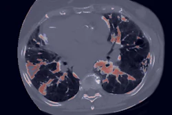 CIPHER, an AI-powered CT foundation model, identifies patients with lung cancer at increased risk of immunotherapy-induced pneumonitis before treatment begins. The AI-generated output, shown here, highlights lung abnormalities to support early risk assessment and personalized patient care.