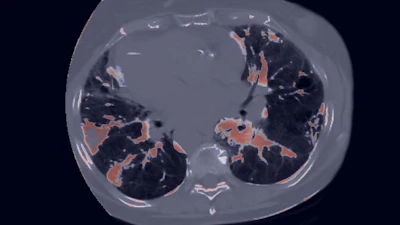 CT-based AI model predicts pneumonitis in lung cancer patients