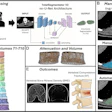 Study overview. (A) Volumetric segmentation of the paraspinal musculature was performed for 1,316 participants. (B) Manual segmentation was performed, the results were compared with the volumetric segmentation results, and the Dice score and the intersection over union were calculated. (C) The three-dimensional segmentations from T1 through T10 were individually extracted and combined into a single volume for analyses. (D) Muscle volume and median muscle attenuation were derived from the segmentation volumes. (E) Analyses were performed to assess the correlation of the paraspinal muscle attenuation and volume with the bone mineral density and the ability to predict vertebral fractures. NIFTI = Neuroimaging Informatics Technology Initiative, 3D = three-dimensional.