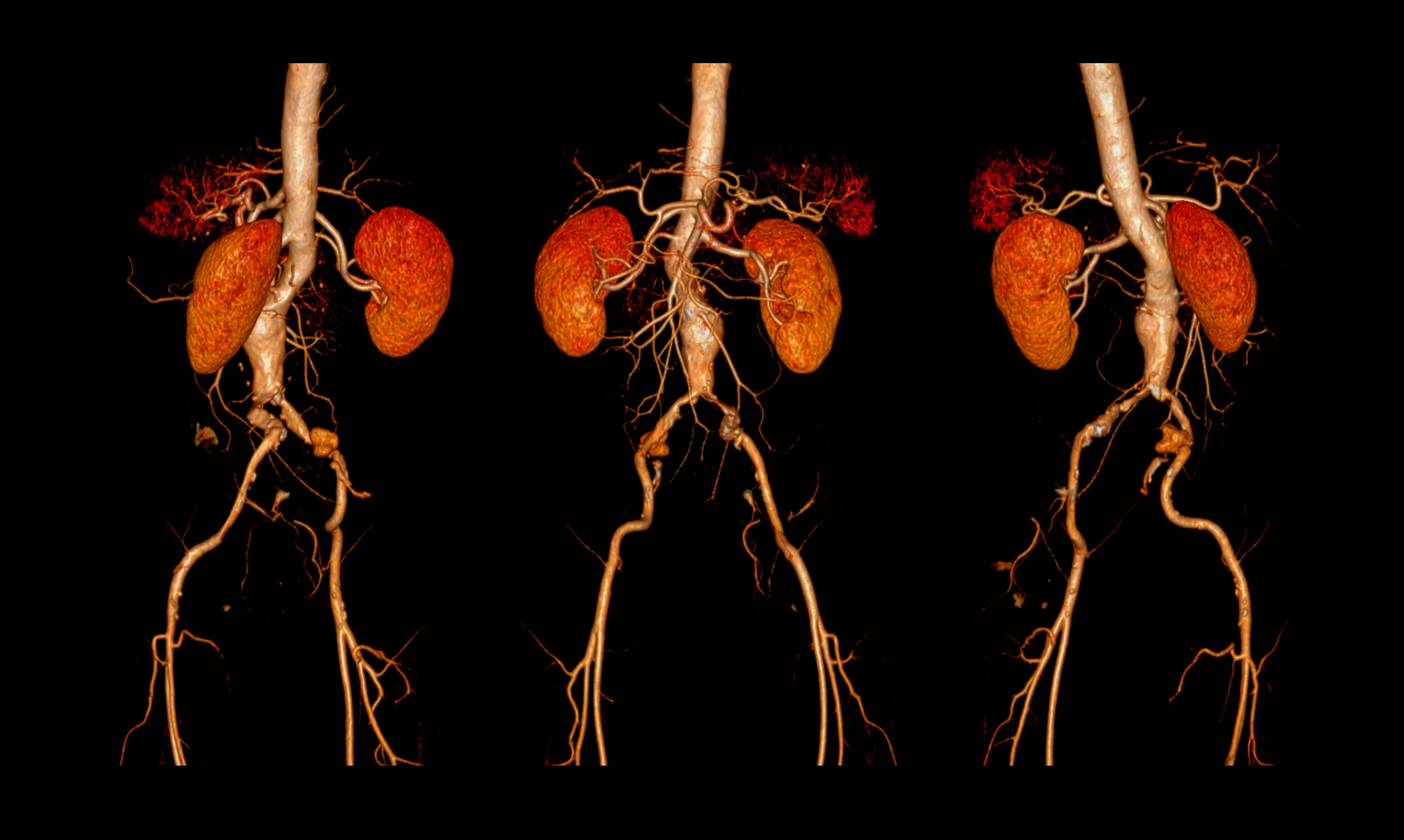 3D medical imaging of kidneys and renal blood vessels shown in three anatomical views