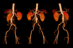 3D medical imaging of kidneys and renal blood vessels shown in three anatomical views
