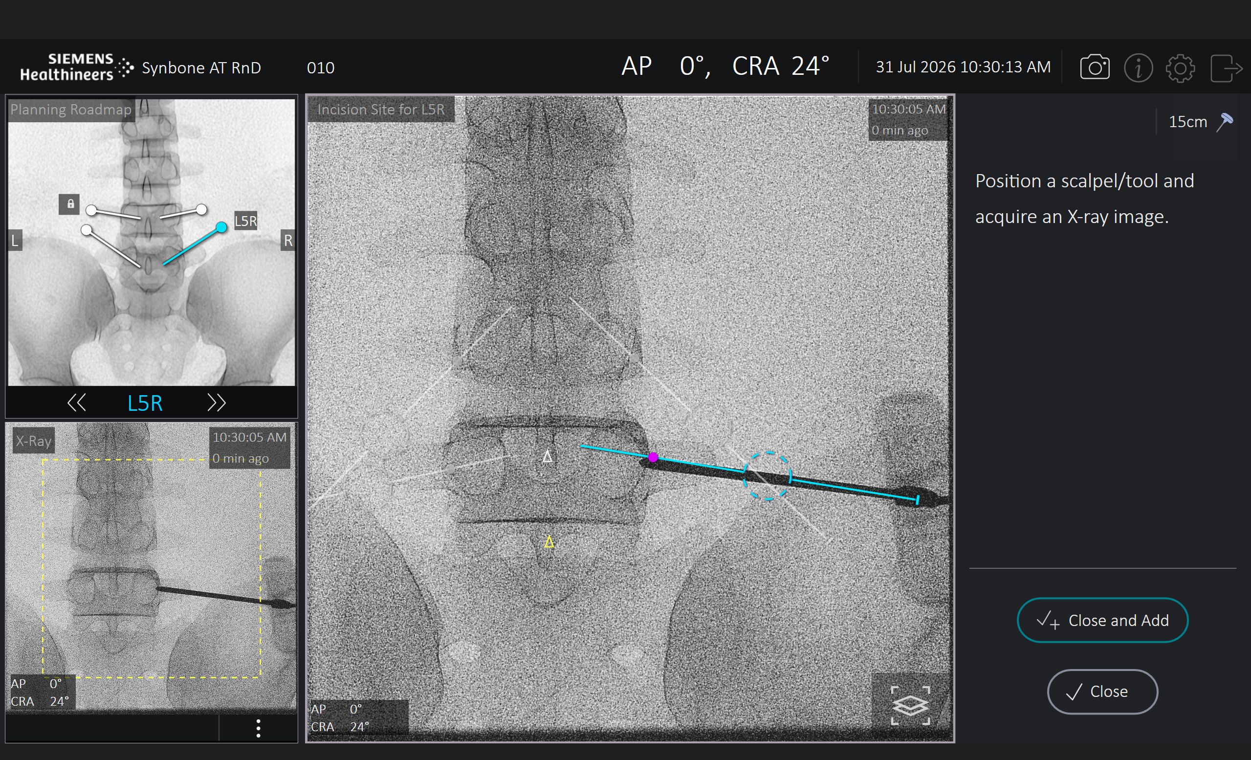 Image Vuze Spinal Surgery Guidance Software