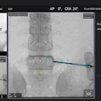Image Vuze Spinal Surgery Guidance Software
