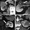 Example subclasses of Bosniak III and Bosniak IV according to Bosniak Classification version 2019 criteria. (A) Contrast-enhanced CT scan in a 55-year-old female patient with a Bosniak III subclass mass with thickened (≥4 mm) smooth walls or septa in the lower pole of the right kidney (arrow), (B) contrast-enhanced MRI scan in a 45-year-old male patient with a Bosniak III subclass mass with an obtuse protrusion (≤3 mm) in the interpolar right kidney (arrows), (C) contrast-enhanced MRI scan in a 51-year-old female patient with a Bosniak IV subclass mass with an obtuse protrusion (≥4 mm) in the interpolar left kidney (arrow), and (D) contrast-enhanced CT image in a 55-year-old female patient with a Bosniak IV subclass mass with acutely angulated protrusions in the interpolar right kidney (arrow).