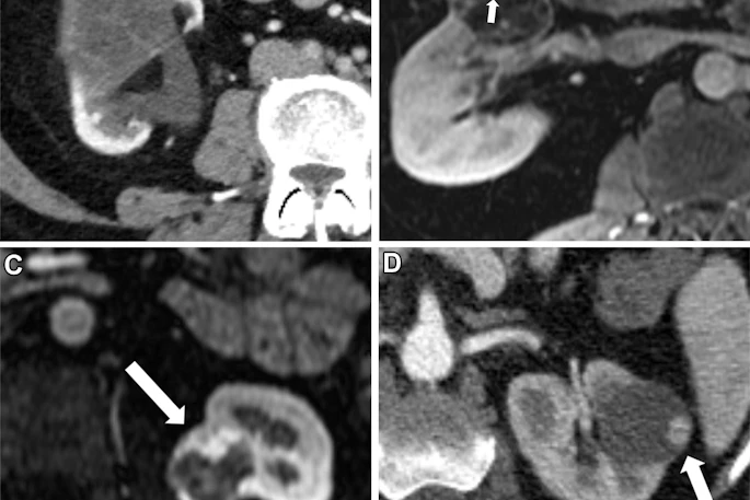 Example subclasses of Bosniak III and Bosniak IV according to Bosniak Classification version 2019 criteria. (A) Contrast-enhanced CT scan in a 55-year-old female patient with a Bosniak III subclass mass with thickened (≥4 mm) smooth walls or septa in the lower pole of the right kidney (arrow), (B) contrast-enhanced MRI scan in a 45-year-old male patient with a Bosniak III subclass mass with an obtuse protrusion (≤3 mm) in the interpolar right kidney (arrows), (C) contrast-enhanced MRI scan in a 51-year-old female patient with a Bosniak IV subclass mass with an obtuse protrusion (≥4 mm) in the interpolar left kidney (arrow), and (D) contrast-enhanced CT image in a 55-year-old female patient with a Bosniak IV subclass mass with acutely angulated protrusions in the interpolar right kidney (arrow).