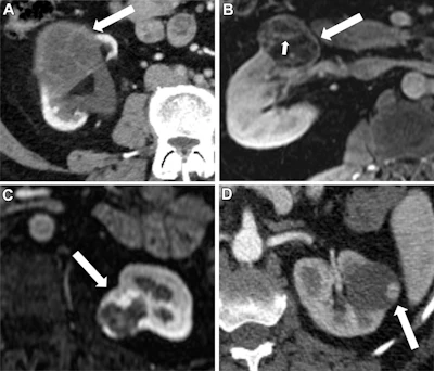 Example subclasses of Bosniak III and Bosniak IV according to Bosniak Classification version 2019 criteria. (A) Contrast-enhanced CT scan in a 55-year-old female patient with a Bosniak III subclass mass with thickened (≥4 mm) smooth walls or septa in the lower pole of the right kidney (arrow), (B) contrast-enhanced MRI scan in a 45-year-old male patient with a Bosniak III subclass mass with an obtuse protrusion (≤3 mm) in the interpolar right kidney (arrows), (C) contrast-enhanced MRI scan in a 51-year-old female patient with a Bosniak IV subclass mass with an obtuse protrusion (≥4 mm) in the interpolar left kidney (arrow), and (D) contrast-enhanced CT image in a 55-year-old female patient with a Bosniak IV subclass mass with acutely angulated protrusions in the interpolar right kidney (arrow).