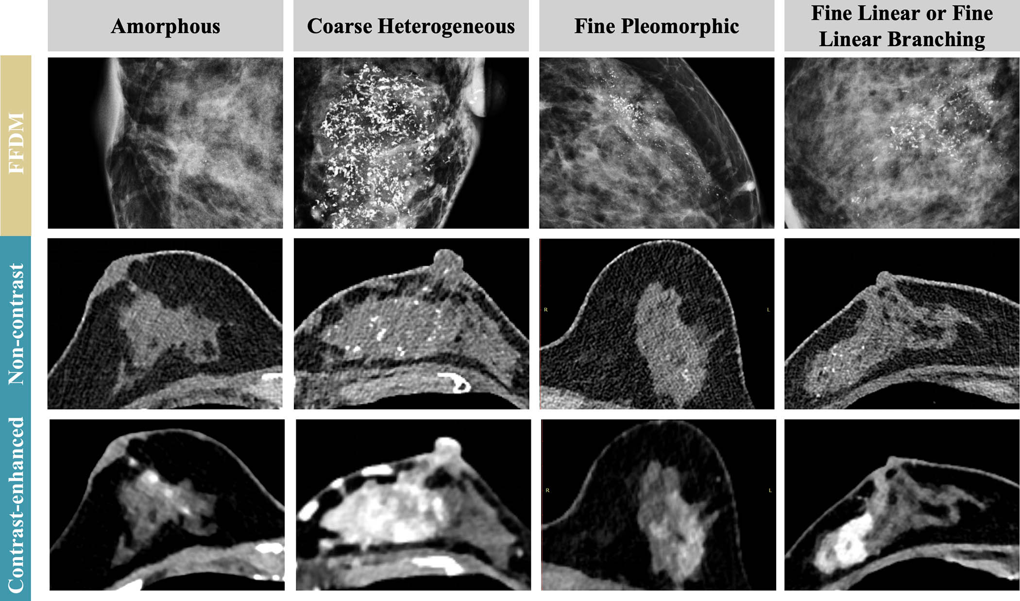 Detection and extent of BI-RADS suspicious calcifications (amorphous, coarse heterogeneous, fine pleomorphic, and fine linear or fine linear branching) at axial photon-counting CT (PCCT) versus full-field digital mammography (first three images, craniocaudal view; last image, mediolateral oblique view). Calcifications found on mammography showed only partial visualization at ultrahigh-resolution PCCT (0.2 mm), while amorphous calcifications could not be distinguished from image noise. Corresponding abnormal enhancement was clearly depicted on contrast-enhanced PCCT images.