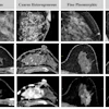 Detection and extent of BI-RADS suspicious calcifications (amorphous, coarse heterogeneous, fine pleomorphic, and fine linear or fine linear branching) at axial photon-counting CT (PCCT) versus full-field digital mammography (first three images, craniocaudal view; last image, mediolateral oblique view). Calcifications found on mammography showed only partial visualization at ultrahigh-resolution PCCT (0.2 mm), while amorphous calcifications could not be distinguished from image noise. Corresponding abnormal enhancement was clearly depicted on contrast-enhanced PCCT images.