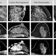 Detection and extent of BI-RADS suspicious calcifications (amorphous, coarse heterogeneous, fine pleomorphic, and fine linear or fine linear branching) at axial photon-counting CT (PCCT) versus full-field digital mammography (first three images, craniocaudal view; last image, mediolateral oblique view). Calcifications found on mammography showed only partial visualization at ultrahigh-resolution PCCT (0.2 mm), while amorphous calcifications could not be distinguished from image noise. Corresponding abnormal enhancement was clearly depicted on contrast-enhanced PCCT images.