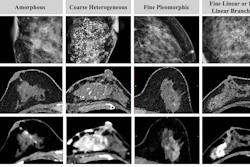 Detection and extent of BI-RADS suspicious calcifications (amorphous, coarse heterogeneous, fine pleomorphic, and fine linear or fine linear branching) at axial photon-counting CT (PCCT) versus full-field digital mammography (first three images, craniocaudal view; last image, mediolateral oblique view). Calcifications found on mammography showed only partial visualization at ultrahigh-resolution PCCT (0.2 mm), while amorphous calcifications could not be distinguished from image noise. Corresponding abnormal enhancement was clearly depicted on contrast-enhanced PCCT images.